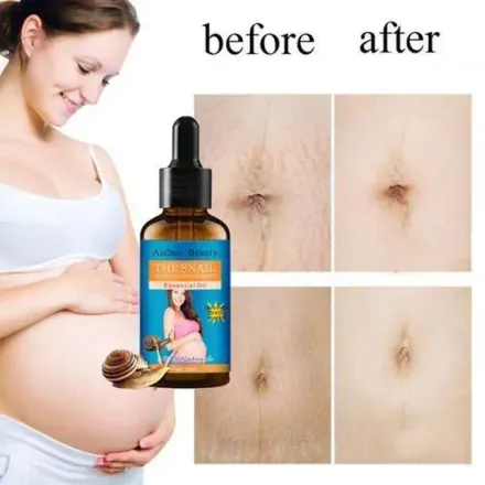 Huile Essentielle - Natural Snail - Élimine Les Vergetures - Réduit La Cellulite thumbnail 2