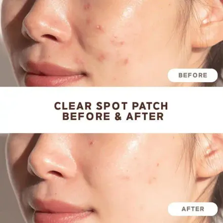 Clear Spot Patch – 26 Patchs thumbnail 4