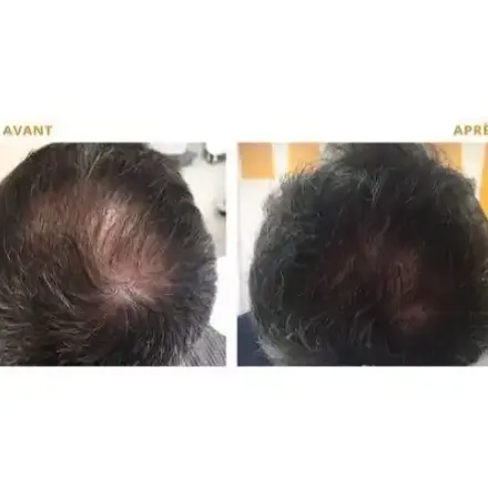 Shampoing Revitalisant Capixyl Blanc Ail thumbnail 4